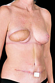 Breast reconstruction surgery scars