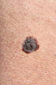 Malignant melanoma