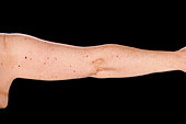 Atypical moles on the arm