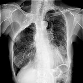 Lung cancer and thoracoplasty, X-ray