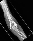 Humerus fracture repair, post-operative X-ray