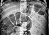 Bowel obstruction, X-ray