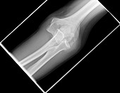 Dislocated elbow, X-ray