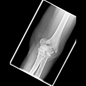 Elbow fracture, X-ray