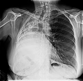 Right pneumonectomy, X-ray