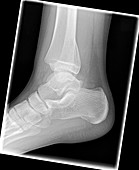 Salter Harris ankle fracture, X-ray