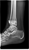 Salter Harris ankle fracture, post-operative X-ray