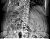Situs inversus, upper abdominal X-ray