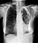 Pulmonary tuberculosis, X-ray