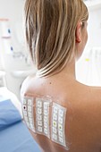 Patient undergoing a patch test in allergy clinic