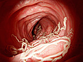 Roundworm infection, illustration