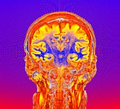 Human brain, coronal MRI scan