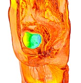 Female bladder, 3D MRI scan