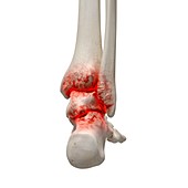 Arthritis in the ankle, illustration
