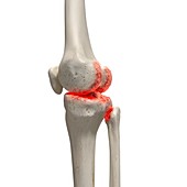 Arthritis in the knee, illustration
