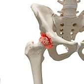 Arthritis in the hip, illustration