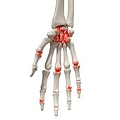Arthritis in the hand, illustration