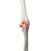Arthritis in the elbow, illustration