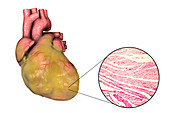 Heart with left ventricular hypertrophy, composite image