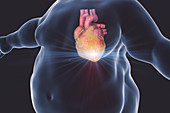 Heart attack in obese man, illustration