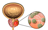 Viral etiology of prostate cancer, conceptual illustration