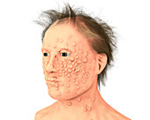 Patient with smallpox, illustration