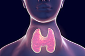 Thyroid goitre, illustration