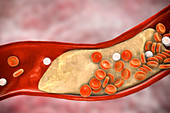 Atheromatous plaque in artery, illustration