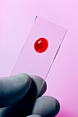 Blood sample on microscope slide