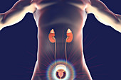 Treatment of prostate gland disease, illustration