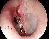 Traumatic perforated eardrum, otoscope view