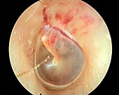 Barotrauma inside the ear, otoscope view