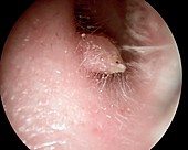 Viral papilloma of the ear canal, otoscope view