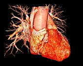 Human heart, 3D CT angiogram