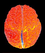 Child's brain, 3D MRI scan