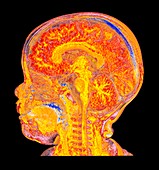 Child's head and brain, sagittal MRI scan