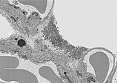 Tubular myelin in alveolar lung fluid, TEM