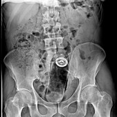 Foreign body in rectum, X-ray