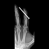 Nail injury to index finger, X-ray