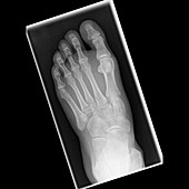 Fractured metatarsal foot bones, X-ray