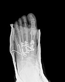 Pinned fractured metatarsal foot bones, X-ray