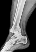 Fractured ankle bones, X-ray