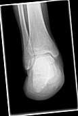 Foot amputation, X-ray