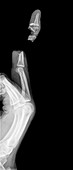 Amputated middle finger, X-ray