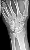Fractured scaphoid wrist bone, X-ray