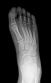 Demineralisation of foot bones, X-ray