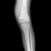 Bone cancer of the leg, X-ray