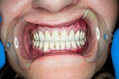 Teeth after dental crown surgery