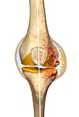 Normal knee and knee with osteoarthritis, illustration