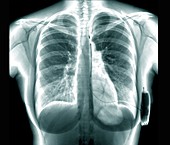 Cardiac defibrillator, chest X-ray